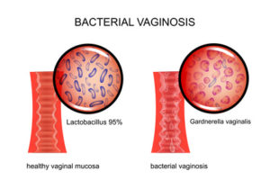 Gardnerella Behandlung ohne Antibiotika