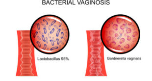 Illustration von Gardnerella Problemen in der Vagina